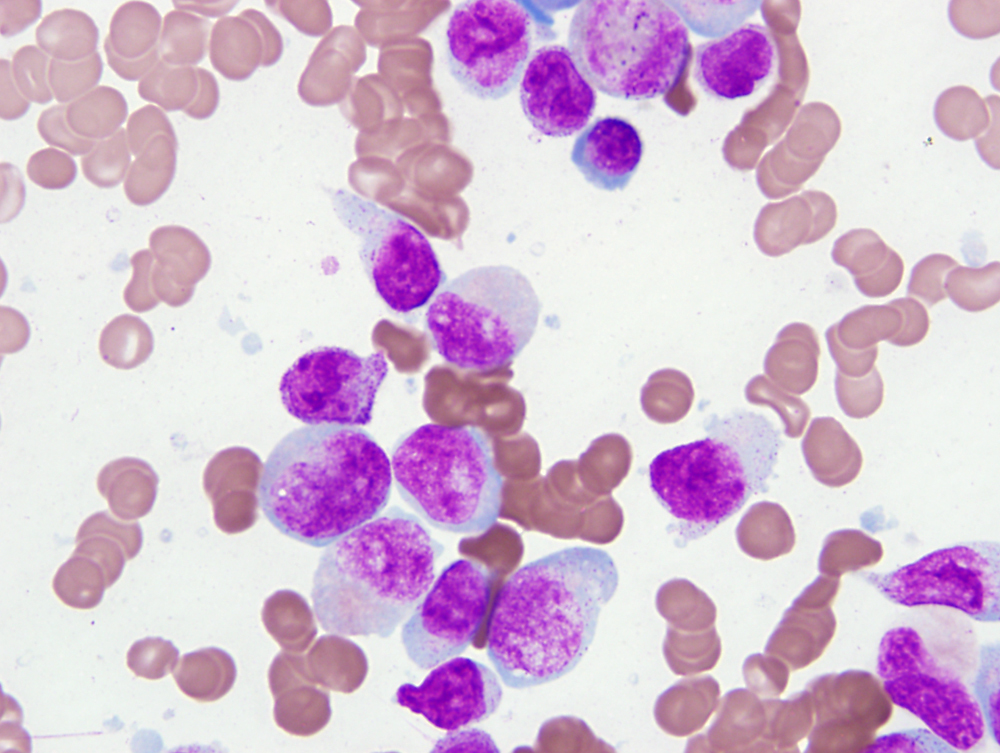 2010 bone marrow aspirate smear: blasts and promonocytes